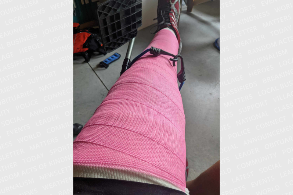 The fourth operation meant a straight leg cast for two months because of the fractured patella.