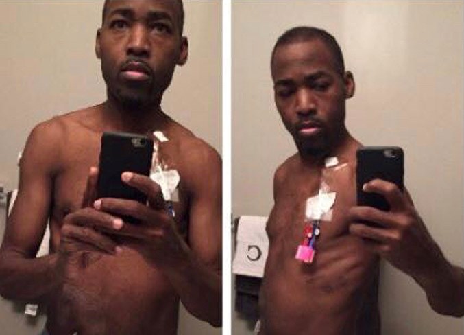 WEB-0203-kidney-sh-chris-charles-before-and-after