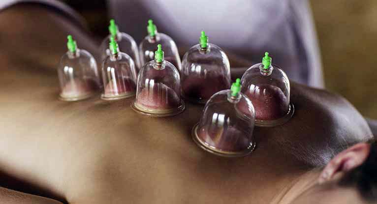 021118_Cupping_Therapy