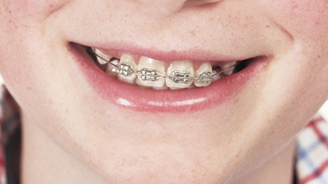 BracesSized