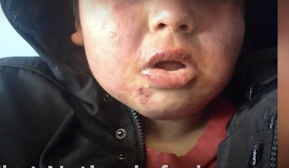 Children at Cat Lake developed skin rashes and respiratory problems. A State of Emergency was declared by the FIrst Nation in January 2019. 