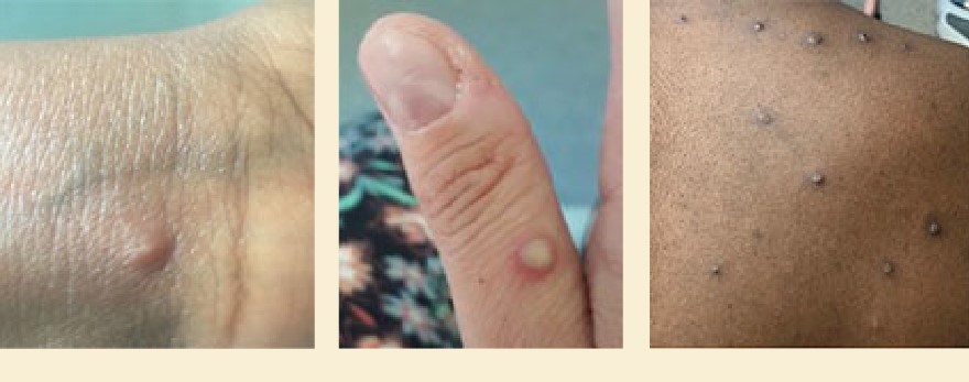 monkeypox rash (2)