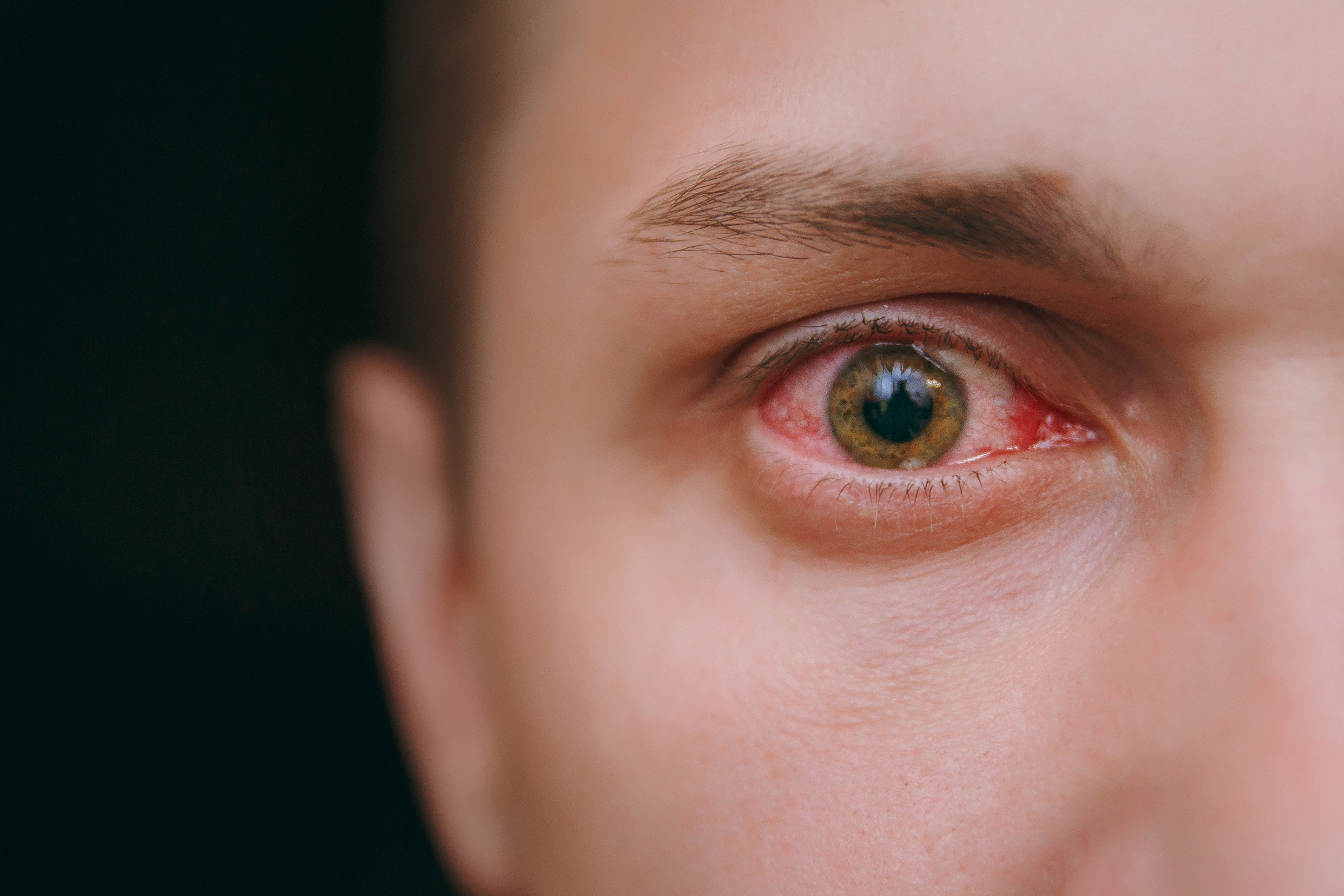 Tak øst Saks Why cannabis might make your eyes red - TBNewsWatch.com