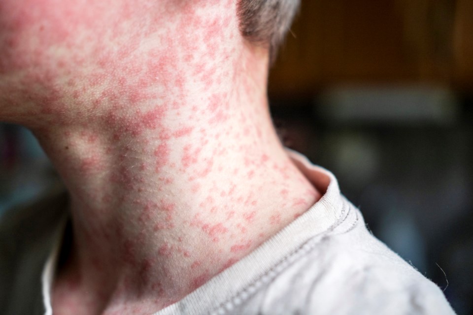 Measles is a highly contagious disease that can spread easily to others through the air (Natalya Maisheva photo)