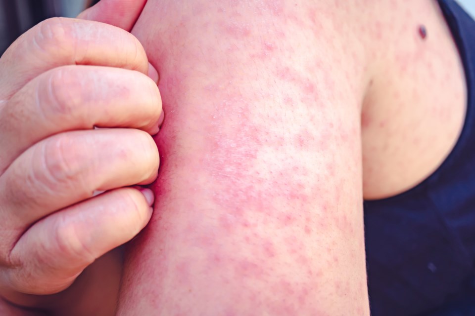 measles-istock-1196157315