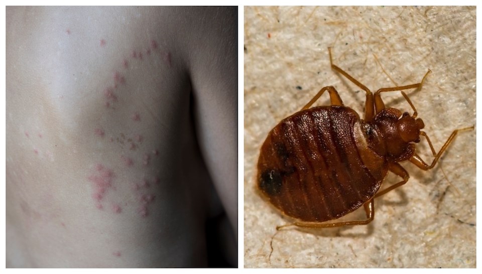 vancouver-rent-bed-bug-bites-april-2023