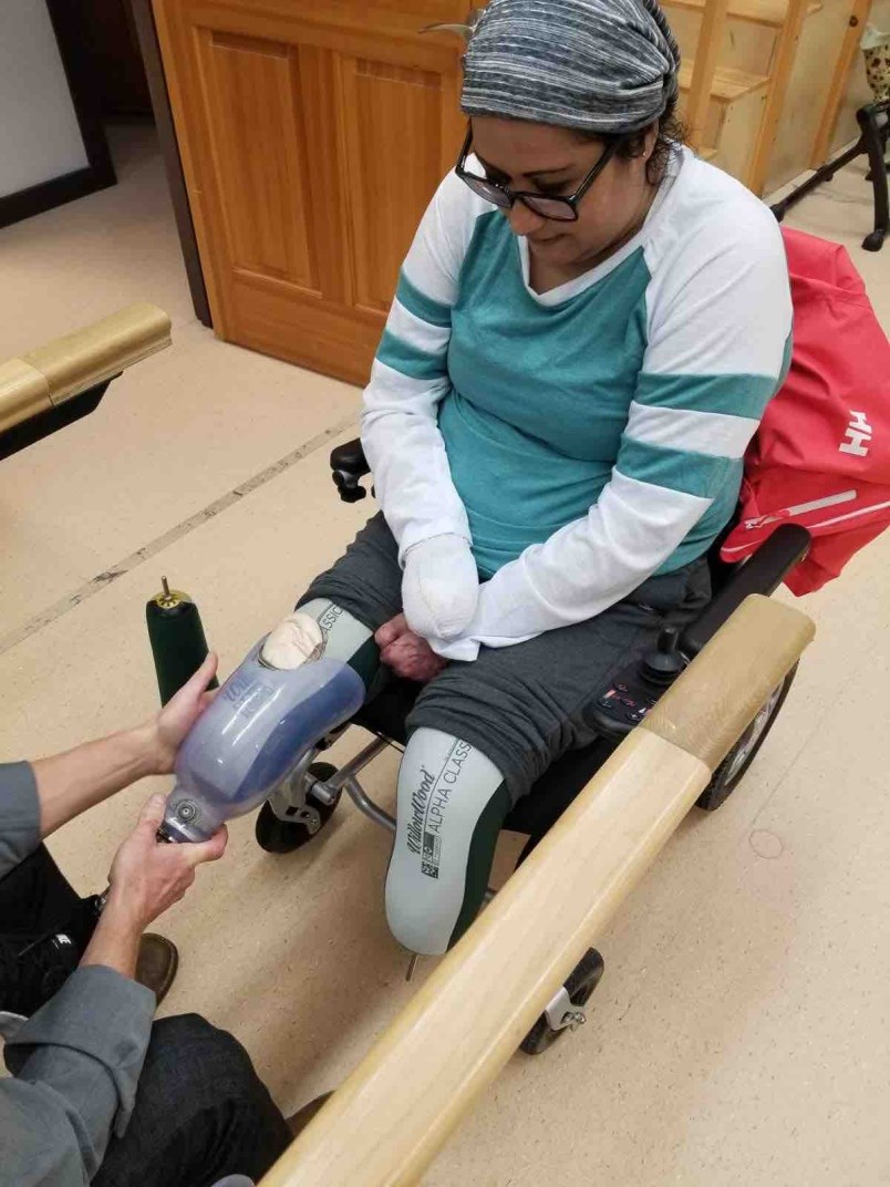 long-tries-on-her-first-pair-of-prosthetic-feet