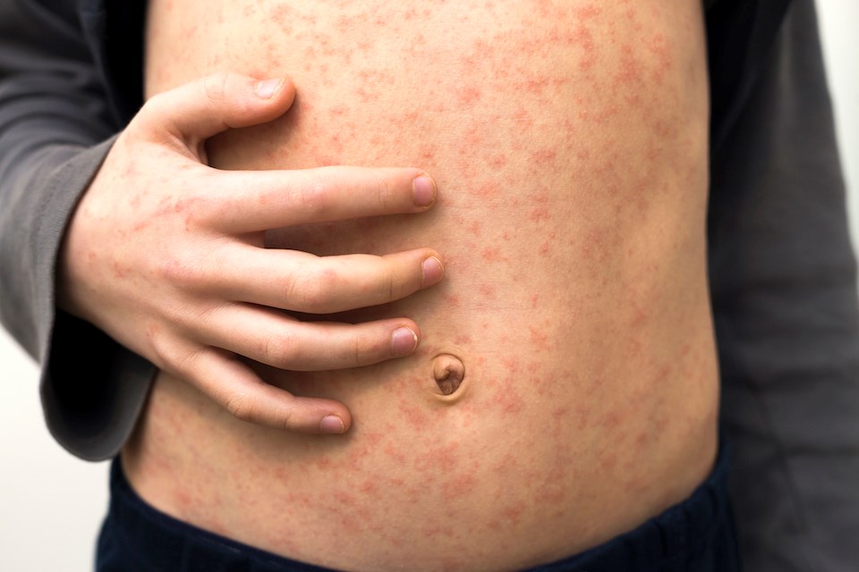 measles-symptoms-vaccine-rash-vancouver