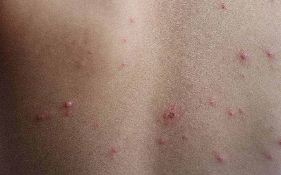 vancouver-flesh-eating-disease-measles-outbreak-travel-vaccine