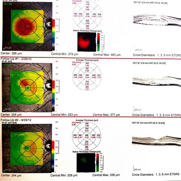 Central Serous Retinopathy chart