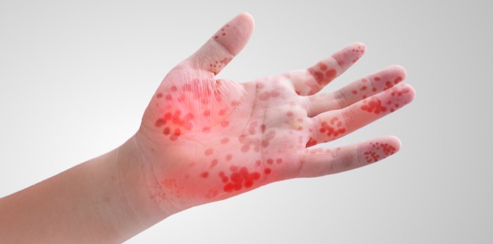  Viral rash/Shutterstock