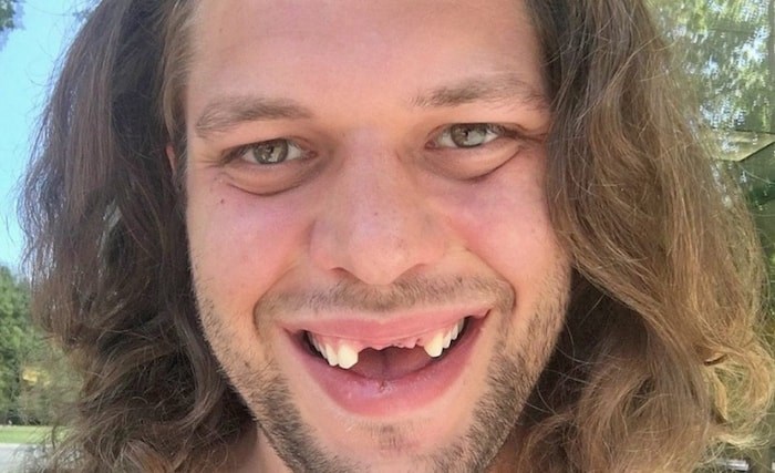  Taylor Fawcett lost his three front teeth this summer.