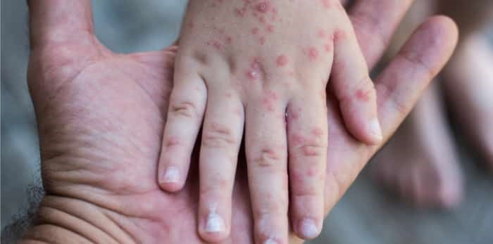 Measles / Shutterstock