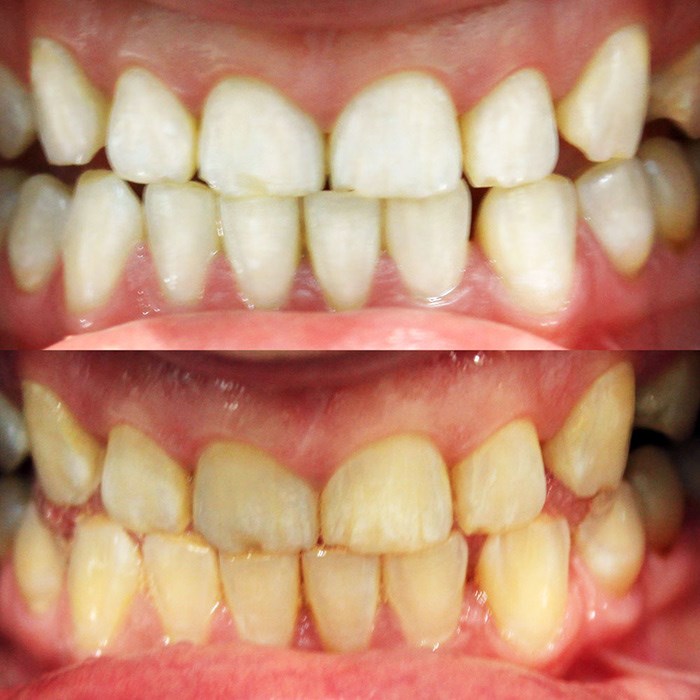  Before and After. Photo: Mint Smilebar