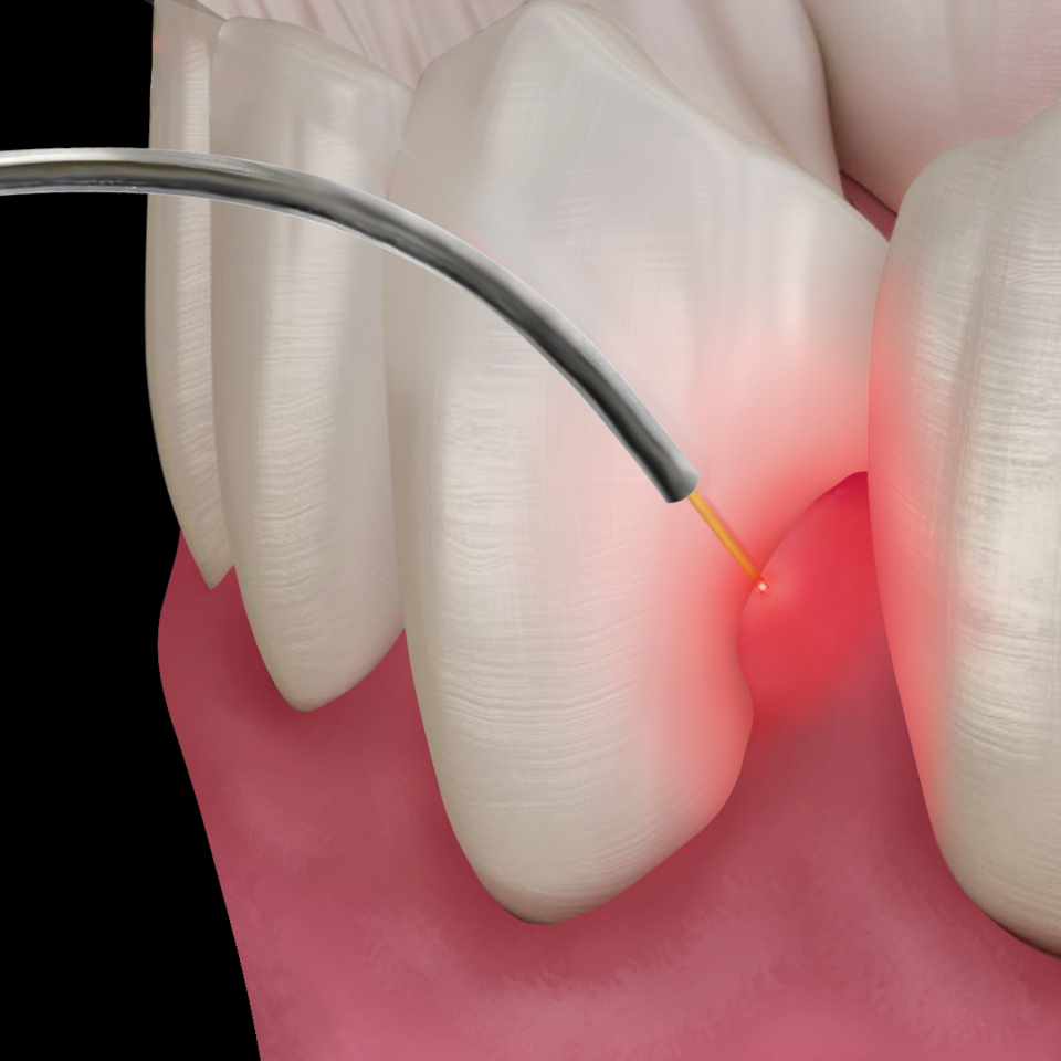 periolase-fiber-next-to-inflammed-gums