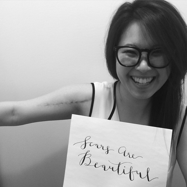 #WeLoveOvey | Ovey Yeung Loves You Back | hit-and-run victim | Scars Are Beautiful